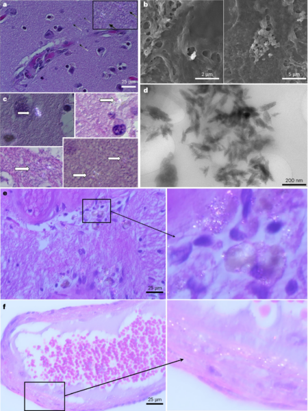 Brain images using different techniques like Polarization wave microscopy, SEM and TEM. Courtesy of Bioaccumulation of microplastics in decedent human brains.